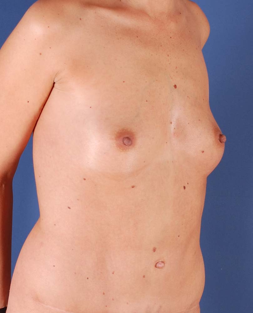 Photo oblique d'une patiente avant son augmentation mammaire avec implants traditionnels par le Dr. Schlaudraff chez Concept Clinic, une clinique de chirurgie esthétique à Genève