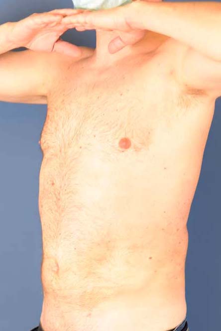Photo oblique d'un patient après une liposuccion pour les hommes par le Dr. Schlaudraff chez Concept Clinic, une clinique de chirurgie esthétique à Genève