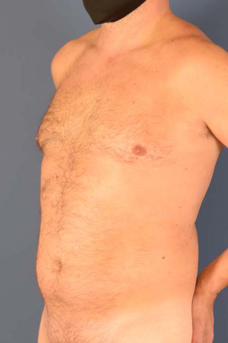Photo oblique d'un patient avant une liposuccion pour les hommes par le Dr. Schlaudraff chez Concept Clinic, une clinique de chirurgie esthétique à Genève